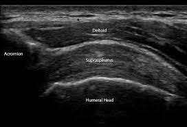 tendinitis